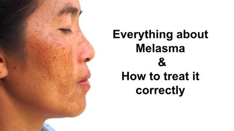 Led Light Treatment For Melasma | Shelly Lighting