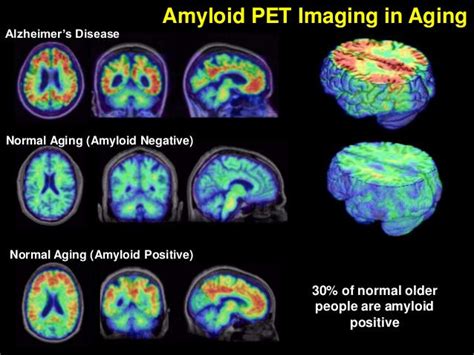 Amyloid PET scan by ApparaoMukkamala on DeviantArt