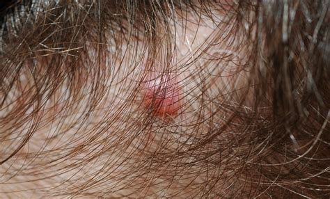 How does a doctor locate melanoma on the scalp? - proquestyamaha.web ...