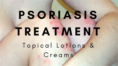 The Best Psoriasis Treatment – Topical Lotion and Cream : Reviews for ...