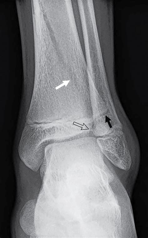 Tough day: Triplane fracture | Radiology Key