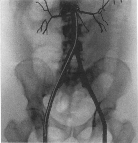 Simulator view of catheter passed from the femoral artery entry site to ...