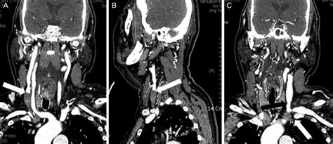 CT images of internal jugular vein thrombosis. Post-contrast neck CT ...