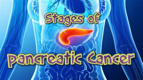 Stages of Pancreatic Cancer