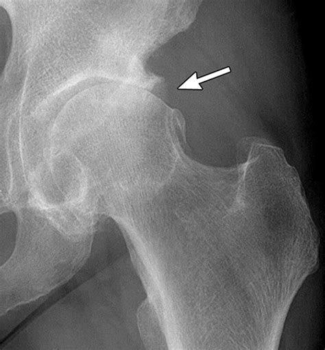 osteoarthritis/DJD - AP hip view shows superolateral joint space ...