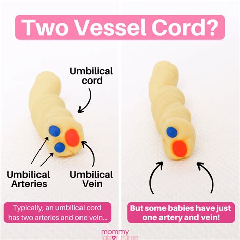 Anatomy Of Umbilical Cord Two Umbilical Arteries And One Umbilical ...