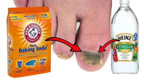 How To Get Rid of TOENAIL FUNGUS With Baking Soda & Vinegar - YouTube ...