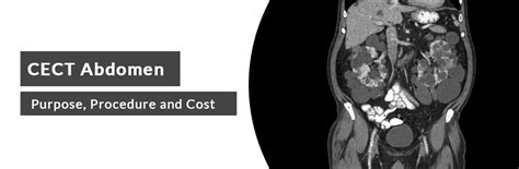 CECT Abdomen: Purpose, Procedure and Cost | Ganesh Diagnostic