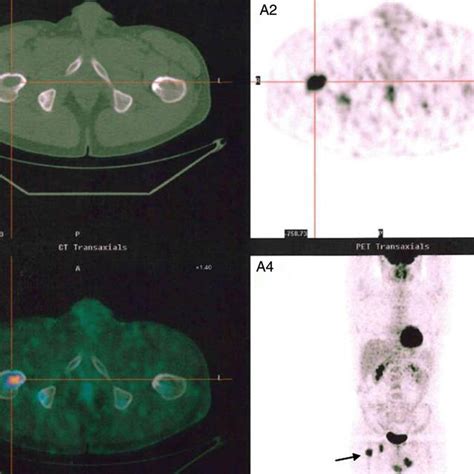 Three-phase bone scan showed increased uptake in the flow phase (A ...