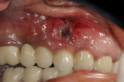 Dental Bone Grafts Complications - Dental News Network