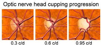 What is glaucoma? How is it treated?