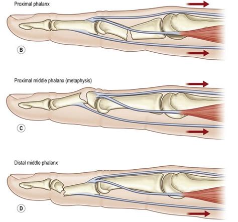 Details 75+ fracture proximal phalanx ring finger - vova.edu.vn