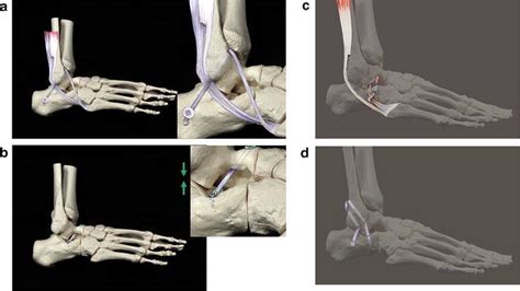 a Principle of extra-anatomic reconstruction of chronic subtalar joint ...