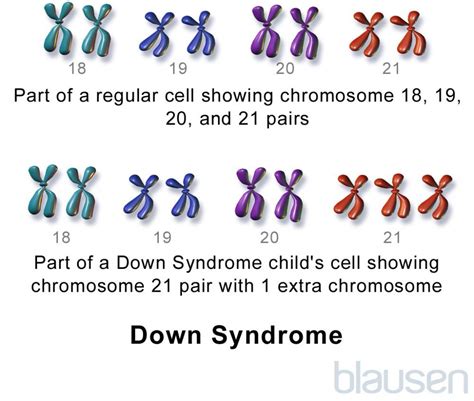 Down Syndrome (Trisomy 21) - Children's Health Issues - MSD Manual ...