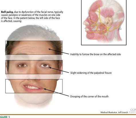 Bell Palsy Causes - Bell S Palsy The Canadian Association Of ...