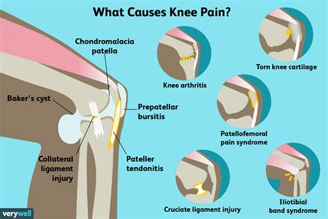 Knee Pain: Causes, Diagnosis, and Treatment