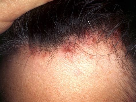 Scalp folliculitis: Symptoms, pictures, causes, shampoos and creams