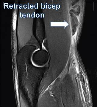 Distal Biceps Rupture Sydney | Tendinopathy Randwick | Australia