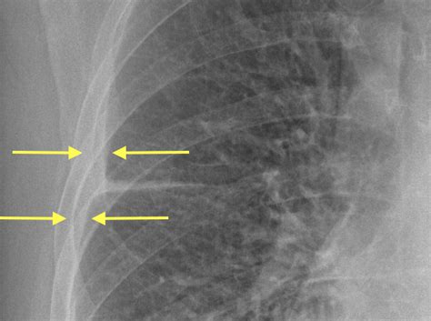 Minor Fissure Chest X Ray