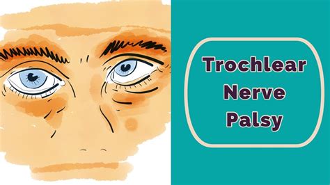 Trochlear Nerve Eye Movement