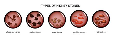 Types of Kidney Stones, Calcium, Uric Acid, Struvite and Cystine - Medfin