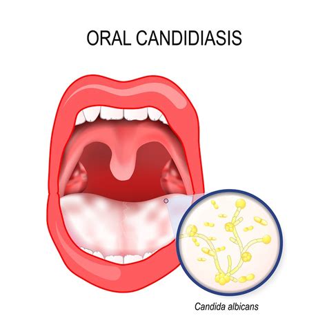 Oral Thrush: Causes, Symptoms, & Remedies