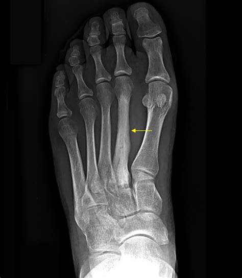 Metatarsal Stress Fracture Mri