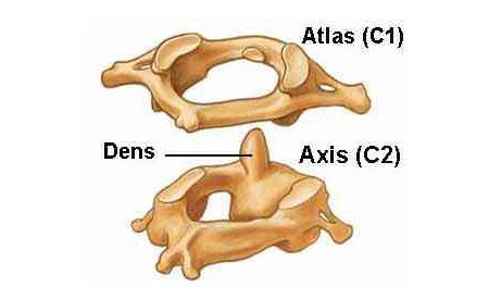 Inestabilidad Atlantoaxial - Down sin mitos