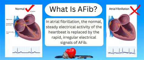 Atrial Fibrillation: Symptoms, Causes, and Treatment | What is AFib ...