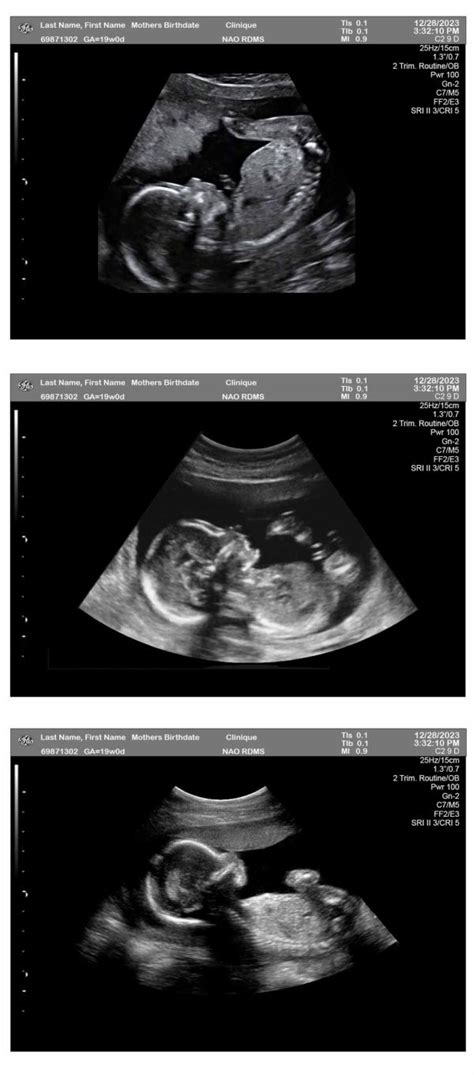 19 Week Pregnancy Ultrasound - Ultrasounds