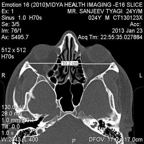 Axial view showing maximum Bizygomatic distance. 2-The Intermaxillary ...