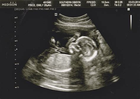 18 Week OBGYN Visit and Ultrasound! | Baby ultrasound pictures, Boy ...