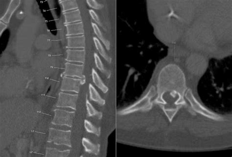 Calcified Thoracic Disc Herniation