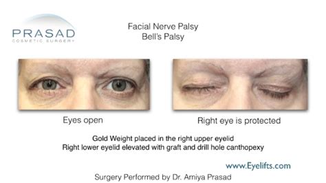 Facial Paralysis Treatment | Specialist in Long Island and NYC