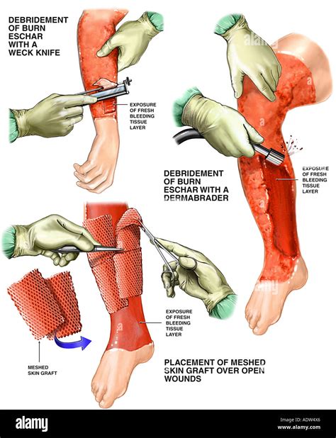 Surgical Debridement of Burns with Skin Grafting Procedure Stock Photo ...