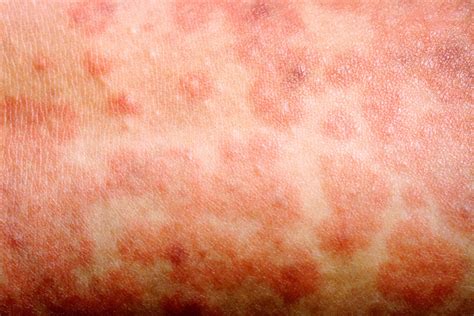 Paano maka-iwas sa tigdas-hangin o german measles? | Mediko.ph