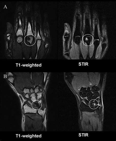 Bone Marrow Edema Is the Most Specific Finding for Rheumatoid Arthritis ...