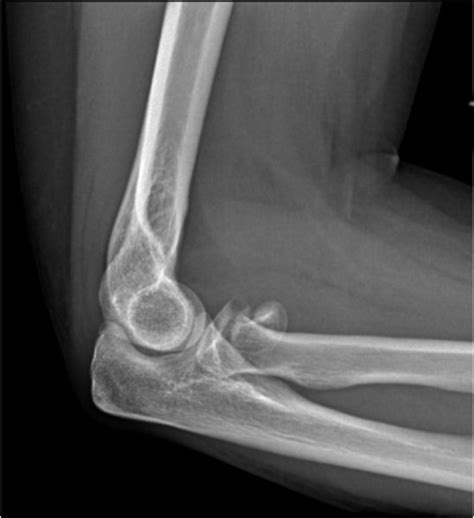 Radial Head Fracture | Arm Docs