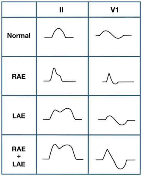 P wave • LITFL • ECG Library Basics