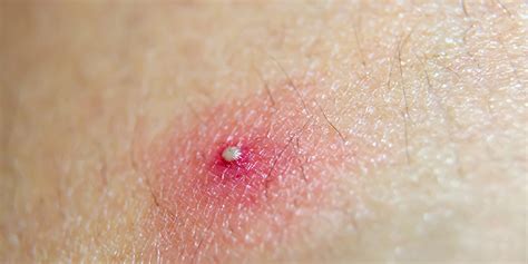 Acne Pustules: Causes, Symptoms, Treatment & Prevention Tips