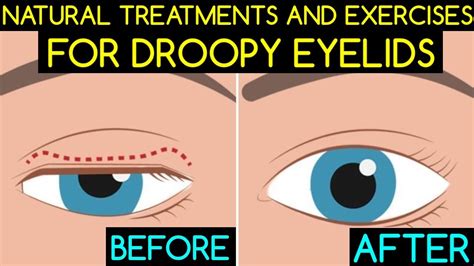 Natural Treatments and Exercises For Droopy Eyelids - YouTube