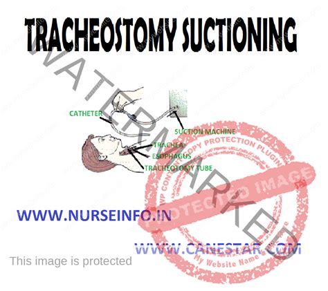 TRACHEOSTOMY SUCTIONING - Nurse Info