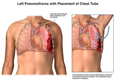 Chest Tube Placement | Lung Care in New Jersey