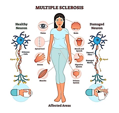 Multiple Sclerosis | Nursing Tutorials