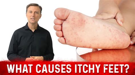 What Causes Itchy Feet| Dr. Berg