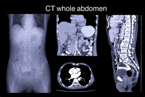 1,397 Abdomen Ct Scan Images, Stock Photos, 3D objects, & Vectors ...