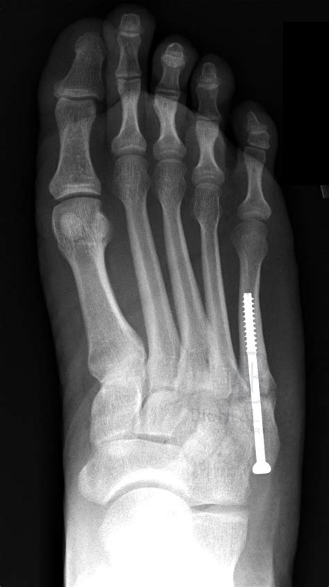 Fifth Metatarsal Fracture Treatment And Tips / Metatarsal Fractures ...