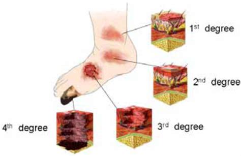 Fourth Degree Burn Diagram