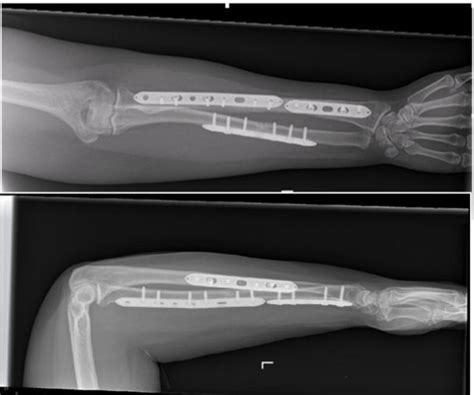 Radius And Ulna Shaft Fracture