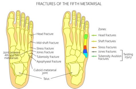 Metatarsal Stress Fracture